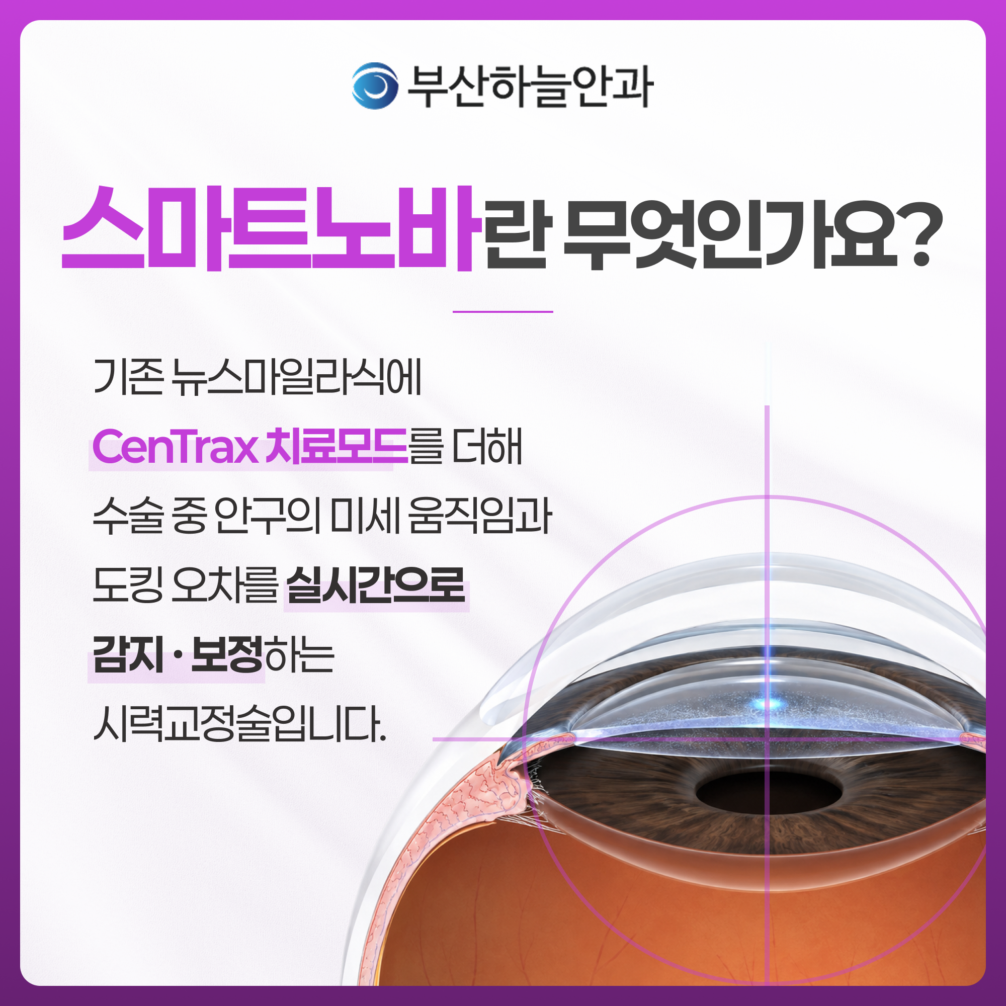 부산안과 스마트노바 라식 안내 이미지 2