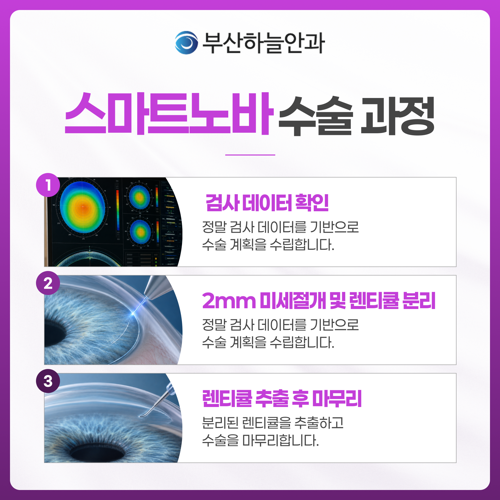 부산안과 스마트노바 라식 안내 이미지 4