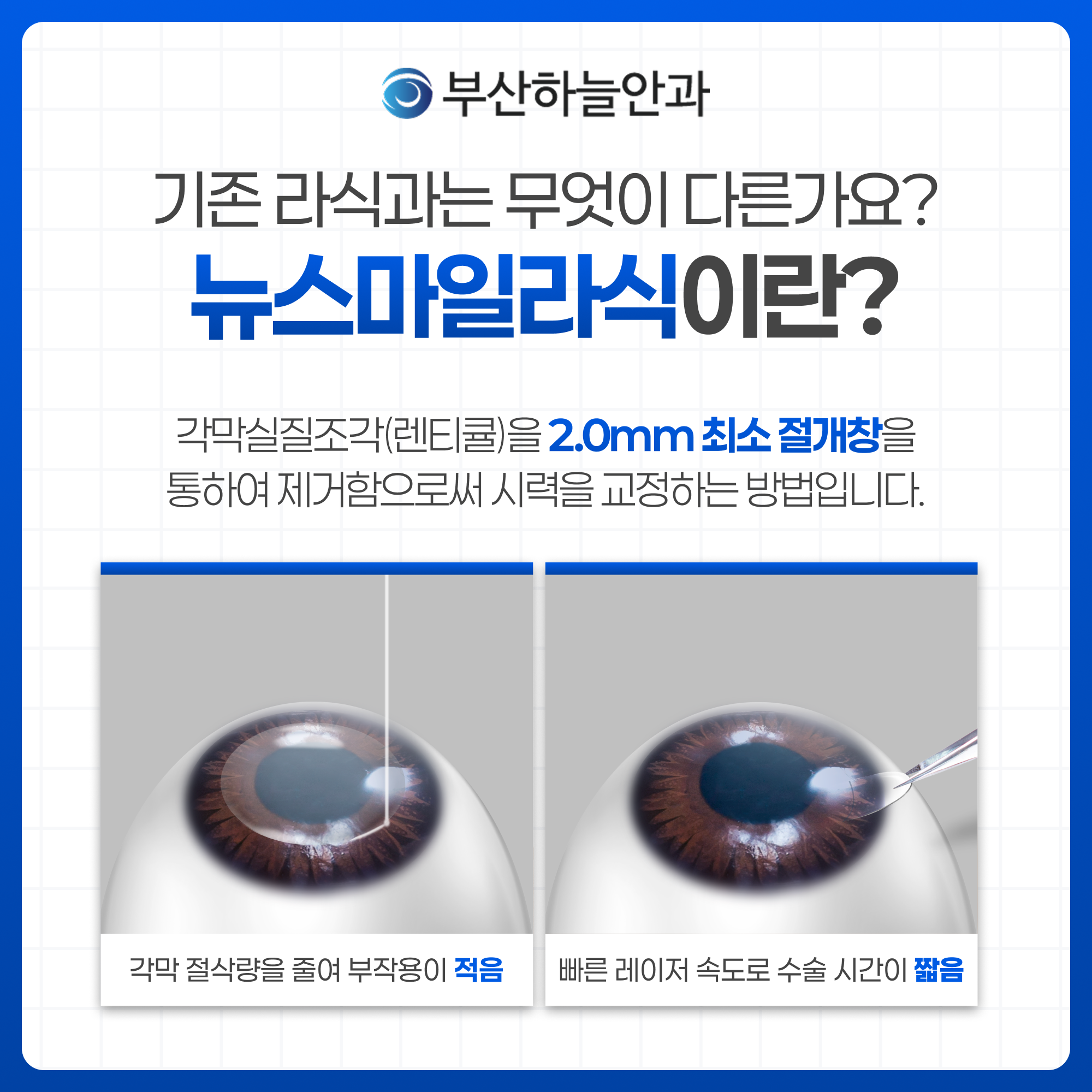 서면안과 뉴스마일라식 안내 이미지 2