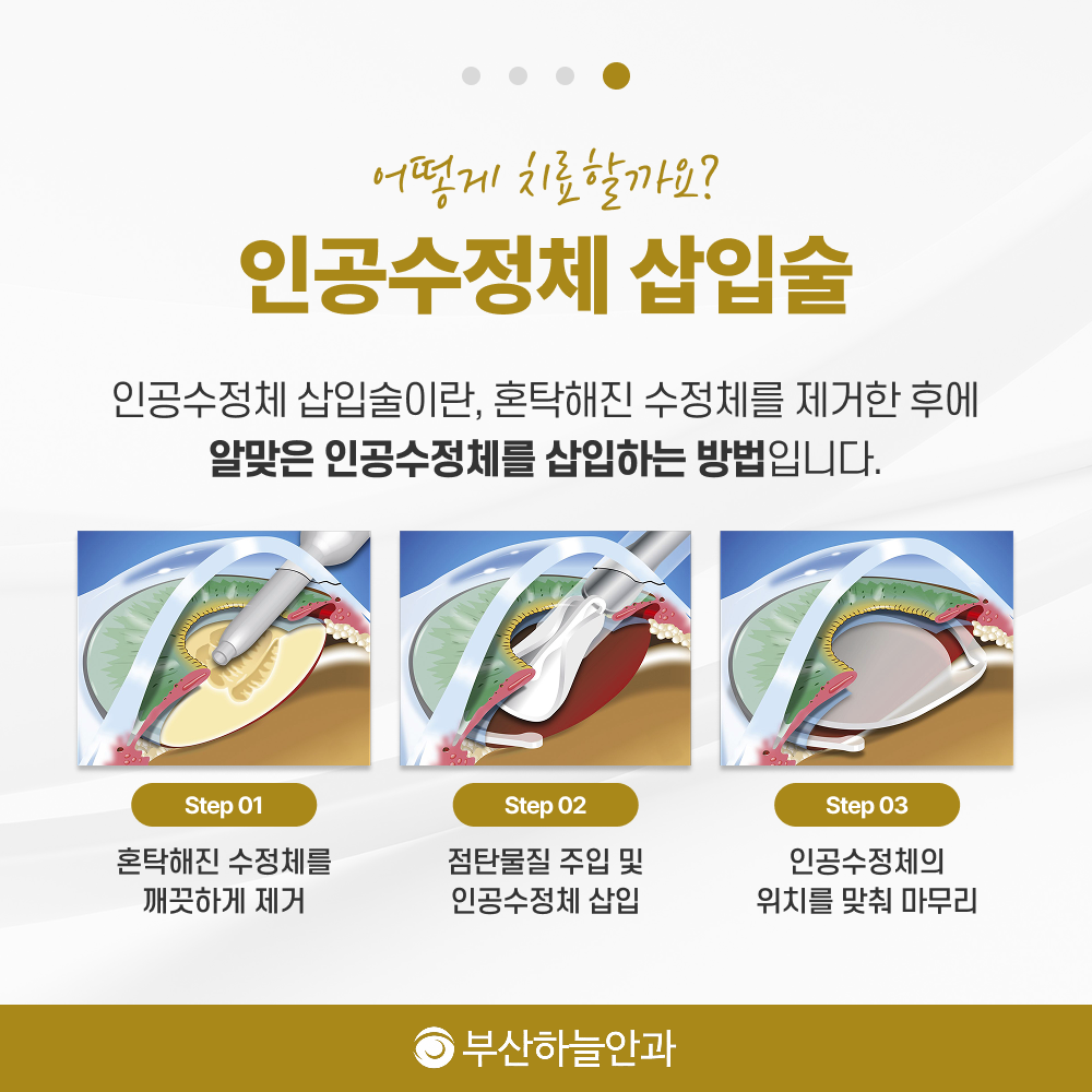 서면역안과추천 노안백내장 안내 이미지 5