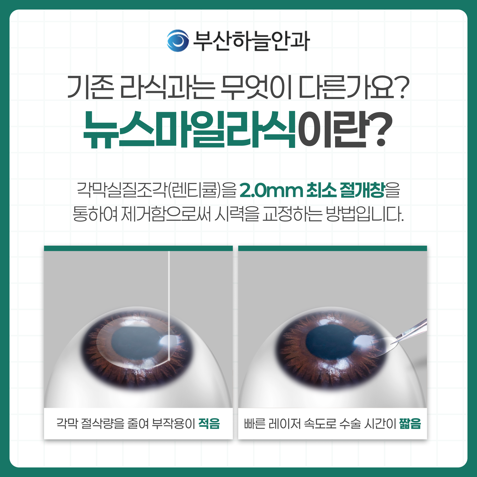 부산안과잘하는곳 뉴스마일 라식 안내 이미지 2