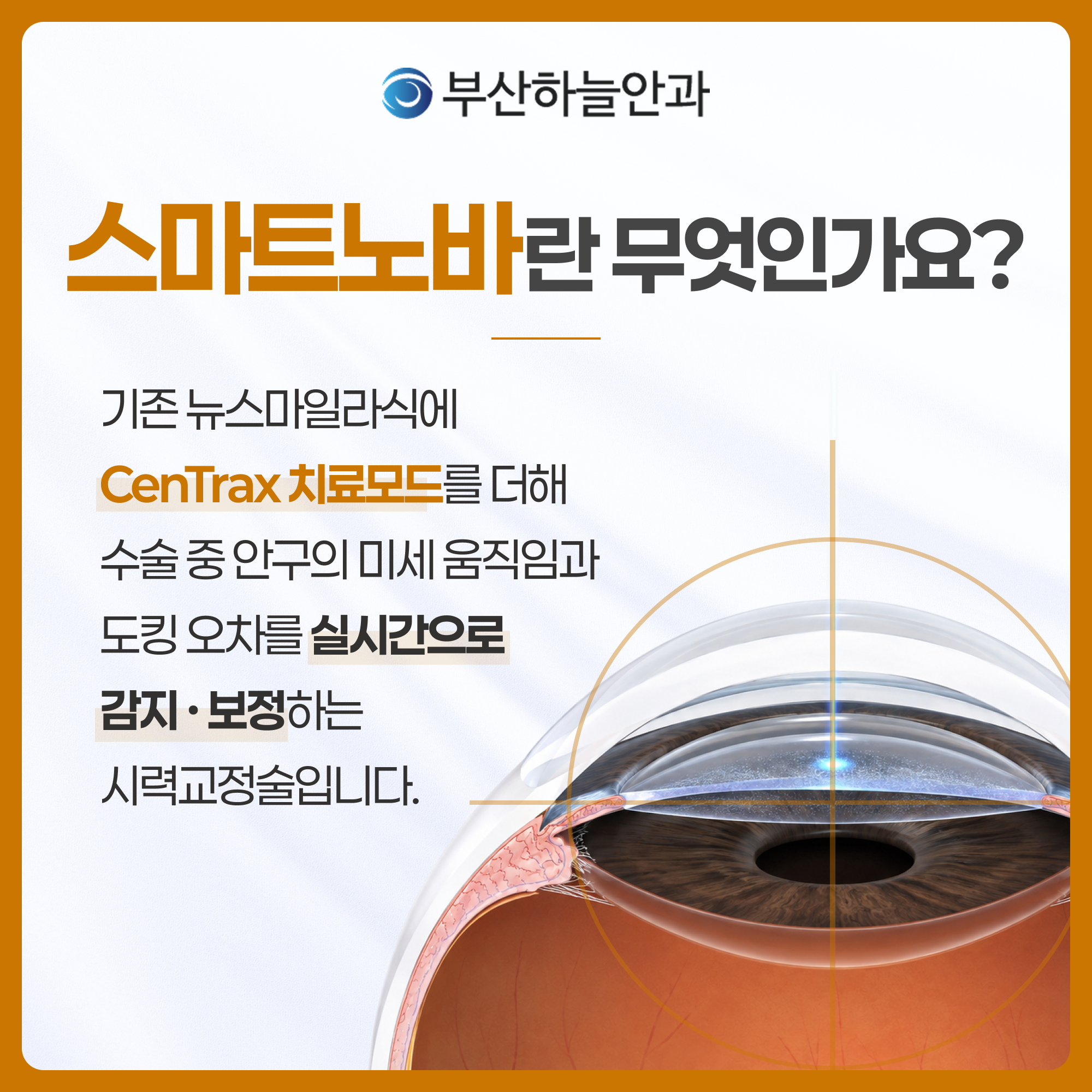 부산서면안과추천 스마트노바 라식 안내 이미지 2