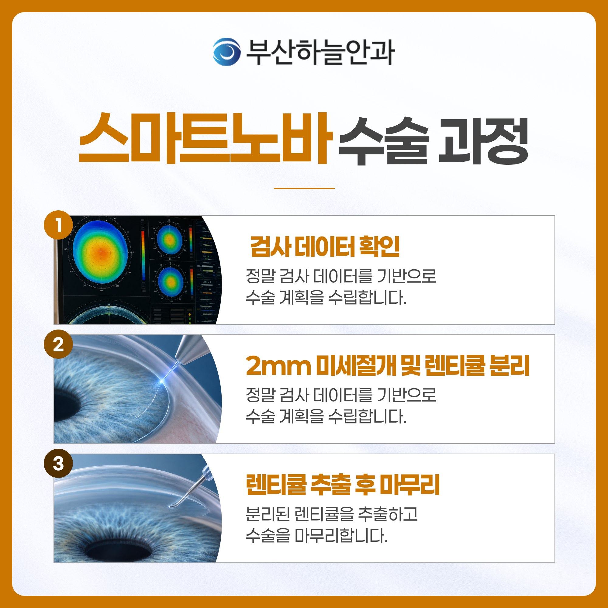 부산서면안과추천 스마트노바 라식 안내 이미지 4