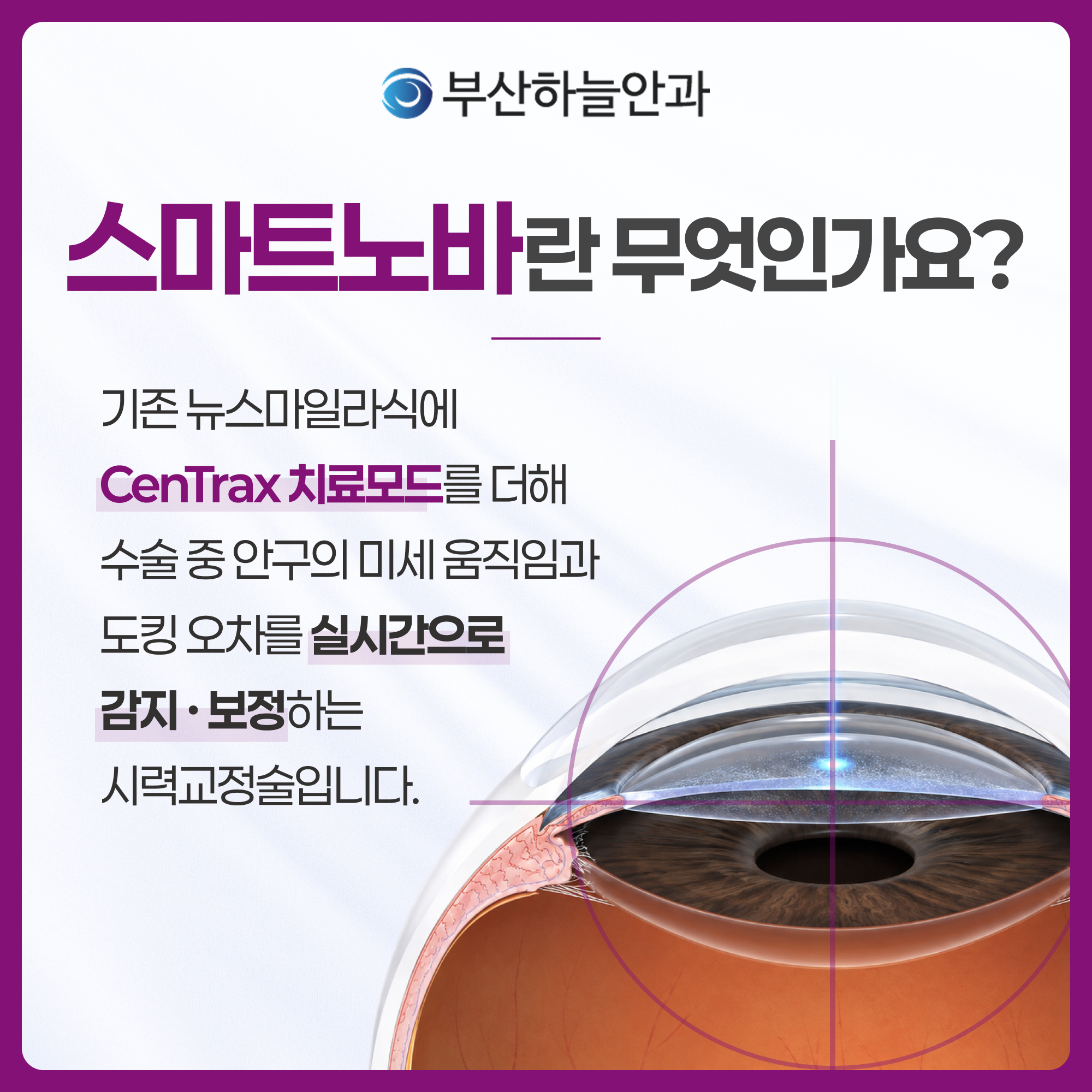 서면역안과 스마트노바 라식 안내 이미지 2