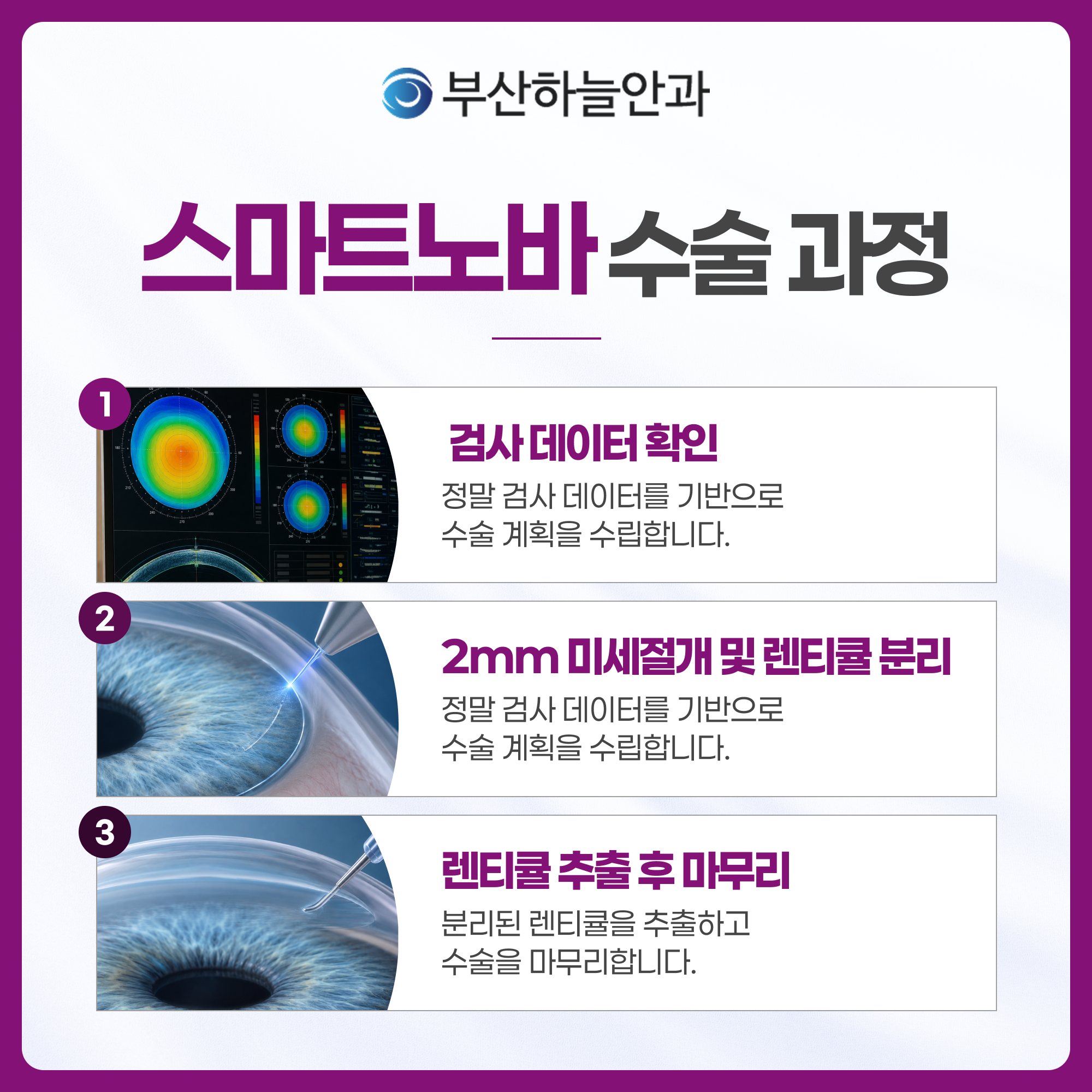 서면역안과 스마트노바 라식 안내 이미지 4