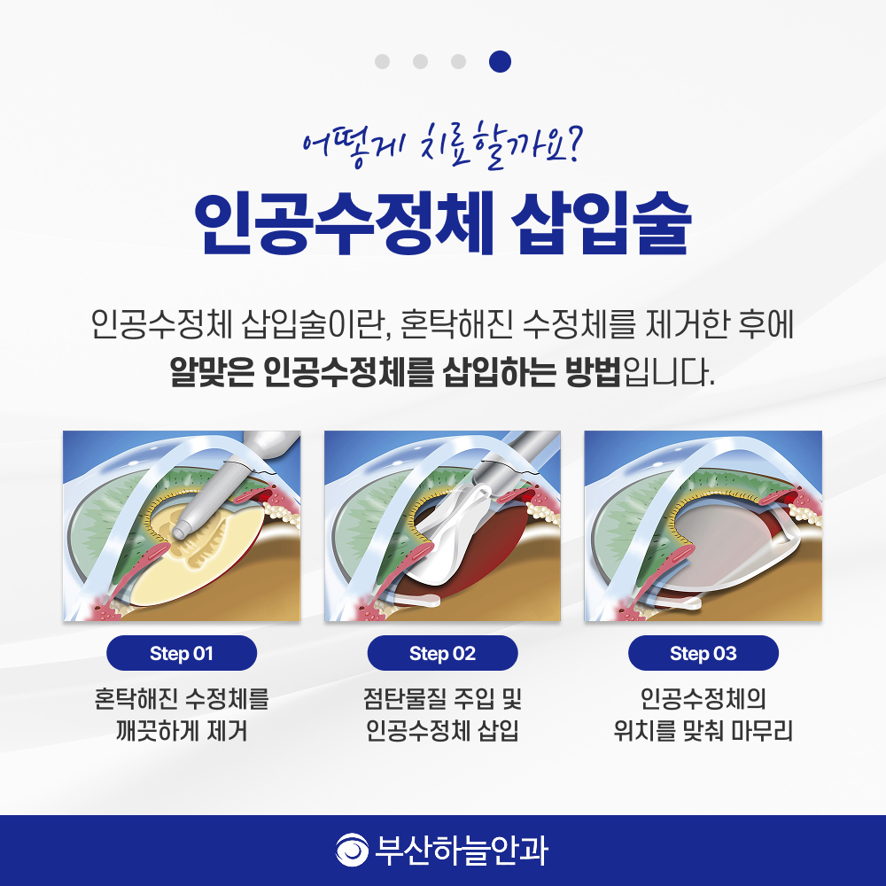서면역안과 노안백내장 안내 이미지 5